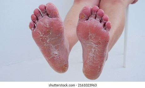 Plantar Warts Are On The Bottom Of The Big Toe Caused By The Human Papillomavirus, Or HPV