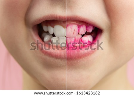 Plaque disclosing tablets in work. Before and after - effect. close up photo of young girl tooth. Dental plaque pill concept