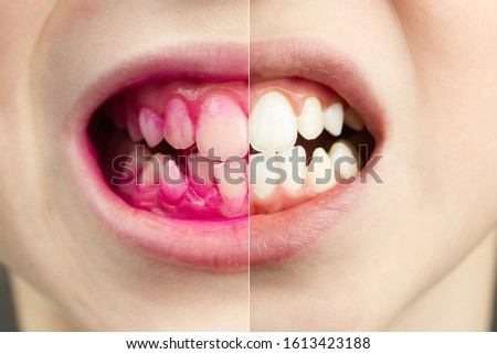 Plaque disclosing tablets in work. Before and after - effect. close up photo of young boy tooth. Dental plaque pill concept