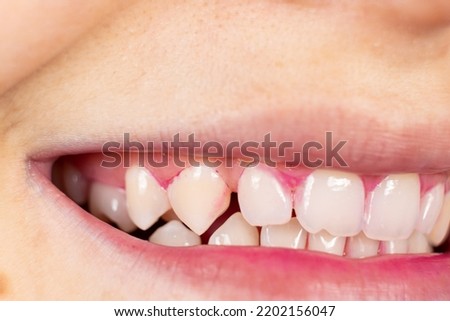 Plaque on human teeth is colored pink with indicator tablets