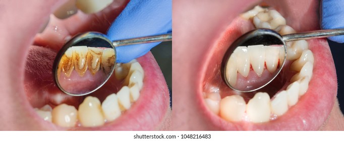 Plaque of the patient, stone. Dentistry treatment of dental plaque, professional oral hygiene. The concept of harm to smoking and cleaning teeth