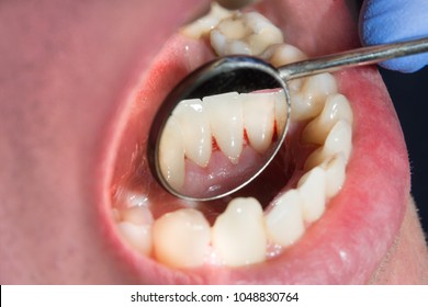 Plaque of the patient, stone. Dentistry treatment of dental plaque, professional oral hygiene. The concept of harm to smoking and cleaning teeth