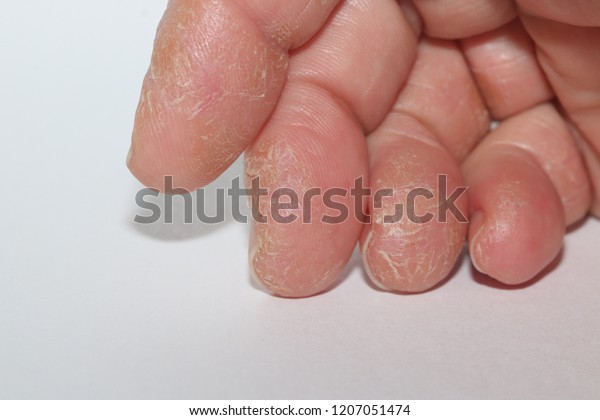 mild psoriasis on hands