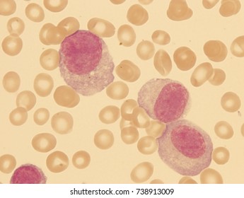 Plasma Cell Leukemia