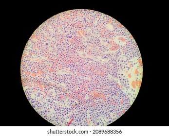 Plasmablastic Anaplastic Multiple Myeloma - Plasmacytoma Biopsy Specimen