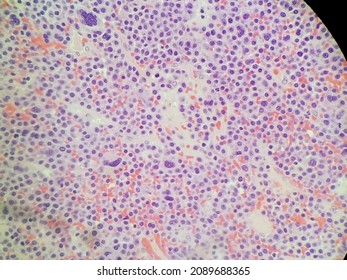 Plasmablastic Anaplastic Multiple Myeloma - Plasmacytoma Biopsy Specimen