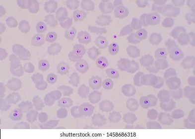 Plasmodium blood parasite ring form stage infected redblood cells.Malaria disease.