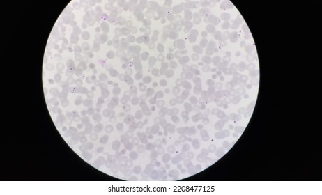 Plasmodium Falciparum Malaria Parasite In Blood Smear