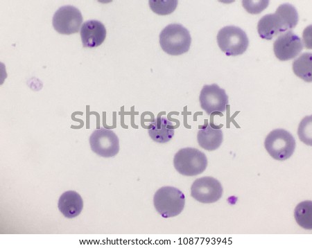 Plasmodium falciparum ; multiple ring cells infection.