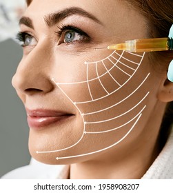 Plasmolifting Skin. Middle-aged Woman With Lifting Arrows On Her Face During Plasma Therapy