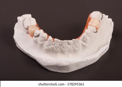 plaster cast of teeth with removable partial denture on a dark background