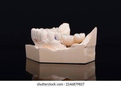 Plaster Lower Jaw Model With Zirconia Teeth On Implants. Process Of Manufacturing Ceramic Teeth On Implants.