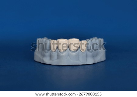 Plaster model of upper jaw with four ceramic veneers placed in front. Concept of cosmetic dentistry, smile design, and dental prosthetics for aesthetic treatment.