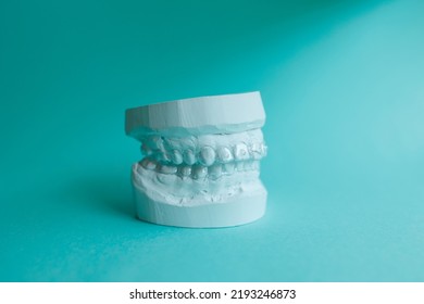 Plaster Mould Of Human Jaw With Transparent Aligner, Invisible Retainer Or Orthodontic Silicone Trainer