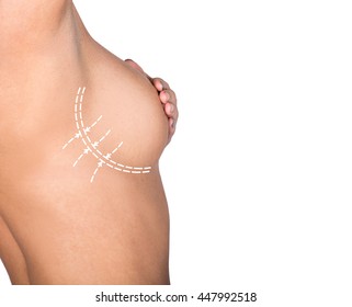 plastic or cosmetic surgery, cellulite correction, people and bodycare concept. female bust with lines. breast augmentation
