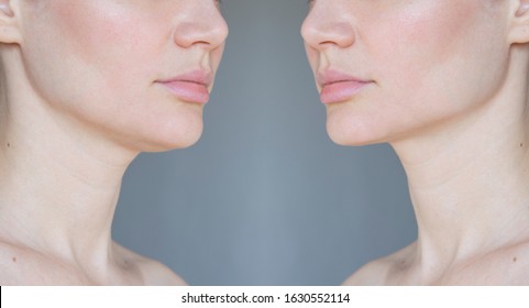 
plastic of the lower third of the face, sagging chin