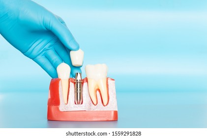Plastic samples of dental implants compare with natural teeth for patients acknowledged the differences Of both types of teeth. To make decisions before beginning dental implant treatment.