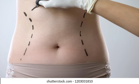 Plastic surgeon preparing for surgery and drawing marks on female abdomen - Shutterstock ID 1203031810