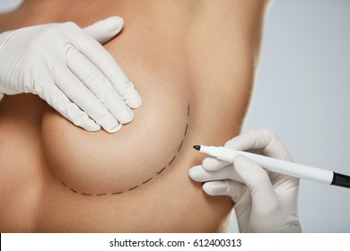 Plastic Surgery. Closeup Of Naked Sexy Woman Body With Black Surgical Marks On Her Breast. Closeup Of Doctor Hands Drawing Lines On Female Breast Before Breast Augmentation Operation. High Resolution