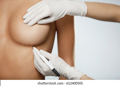 Plastic Surgery. Closeup Of Naked Sexy Woman Body With Black Surgical Marks On Her Breast. Closeup Of Doctor Hands Drawing Lines On Female Breast Before Breast Augmentation Operation. High Resolution