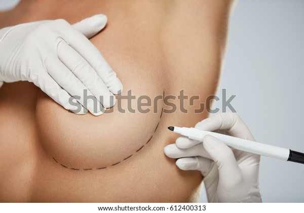 Plastic Surgery. Closeup Of Naked Sexy Woman\
Body With Black Surgical Marks On Her Breast. Closeup Of Doctor\
Hands Drawing Lines On Female Breast Before Breast Augmentation\
Operation. High\
Resolution