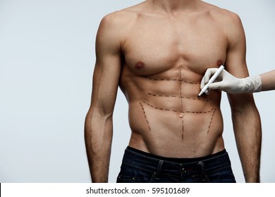 Plastic Surgery. Closeup Of Young Man's Fit Torso With Surgical Lines On His Body Before Beauty Operation. Doctor's Hand In Sterile Glove Drawing Black Marks On Male Patient Body. High Resolution