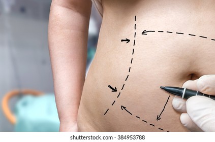 Plastic surgery concept. Hand is drawing lines with marker on belly.