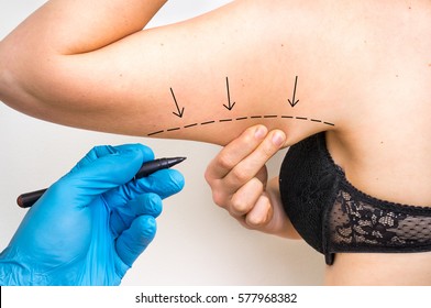 Plastic surgery doctor draw line on patient arm - cosmetic surgery concept