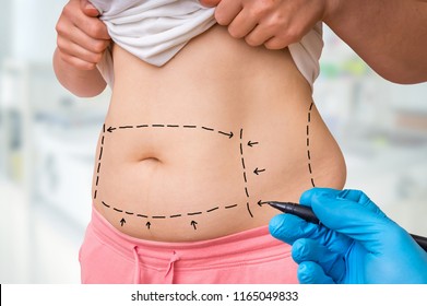 Plastic surgery doctor draw lines with marker on patient belly at clinic