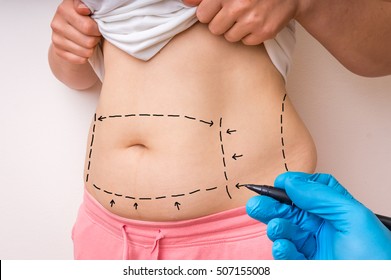 Plastic surgery doctor draw lines with black marker on patient belly - Shutterstock ID 507155008