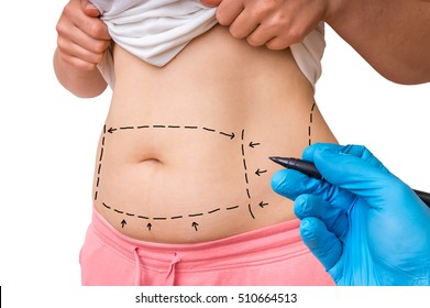 Plastic surgery doctor draw lines with marker on patient belly - isolated on white background - Powered by Shutterstock