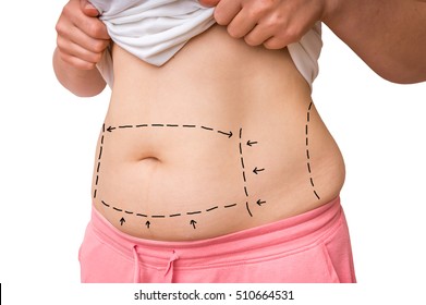 Plastic surgery doctor draw lines with marker on patient belly - isolated on white background