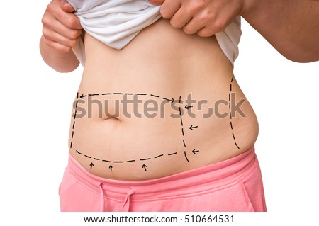 Plastic surgery doctor draw lines with marker on patient belly - isolated on white background
