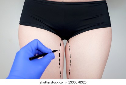 Plastic Surgery: Femoroplasty, Cruroplasty, Buttocks Endoprosthetics, Gluteoplasty. Patient On Consultation With A Plastic Surgeon