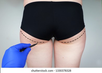 Plastic Surgery: Femoroplasty, Cruroplasty, Buttocks Endoprosthetics, Gluteoplasty. Patient On Consultation With A Plastic Surgeon