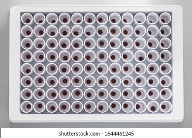 A Plate Filled With Dried Blood Samples. Preparation For Biochemical Analysis. Screening Of Newborns For Hereditary Diseases.