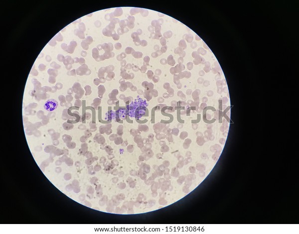 Platelet Clumping Blood Smear Picture Platelet Stock Photo Edit Now