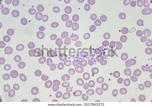 Platelet Clumping Hematology Stock Photo 1017843373 | Shutterstock