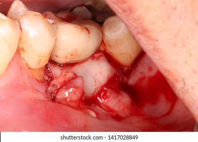 Platelet Rich Fibrin  Was Place Over Bone Graft And Membrane  For  Stimulate Wound Healing 