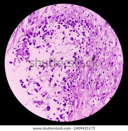 Pleural tissue (biopsy): Section show fibro collagenous tissue. focal area of atypical looking cells admixed with inflammatory cells.