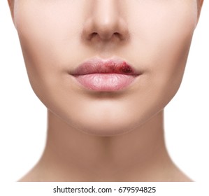 Plump female lips with herpes sore.