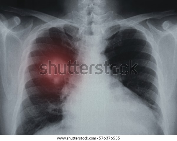 Pneumonialung Tuberculosis Xray Image Patient Lungs Stock Photo ...