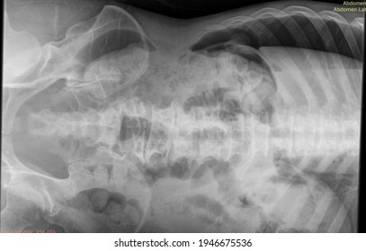 Pneumoperitoneum Free Air In Abdomen Xray 