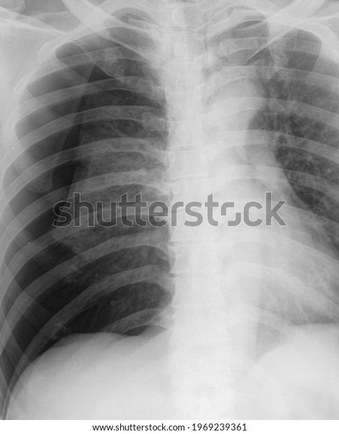 Pneumothorax Free Air Right Hemithorax Tension Stock Photo 1969239361 ...