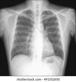 Chest Xray Vascular Access Permacath Insertion Stock Photo 1593331306 ...