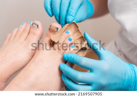 Podiatrist in blue gloves inserts a silicone impression to fix the ingrown toenail on the client's big toe. Close-up. The concept of podology and chiropody.