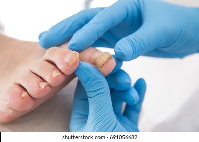 Podiatrist treating toenail fungus. Podology treatment. 