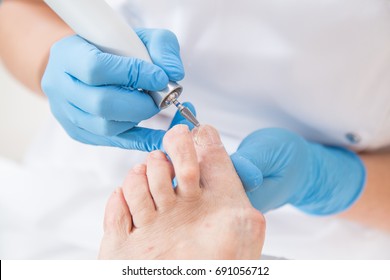 Podiatrist treating toenail fungus. Podology treatment. 