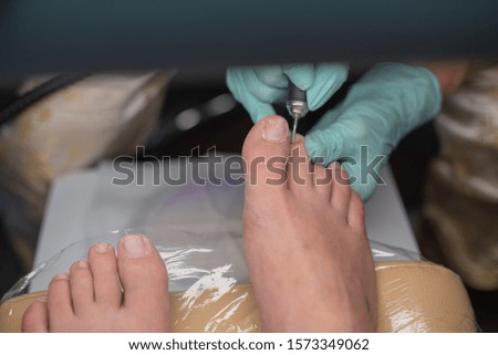 Podiatrist treating toenail. Podology treatment. Podology of applying gel polish to remove onycholysis. The procedure for treating the nail plate with a podologist in a medical office