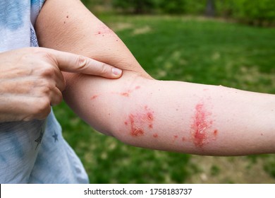Pointing at itchy poison ivy / poison oak rash and infection with blisters and oozing